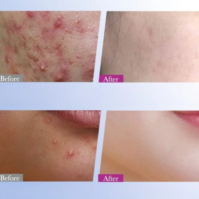 Patchs HydroGlow - application